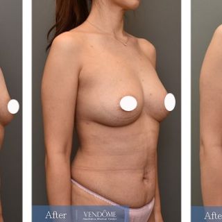 療程效果因人而異，上圖為D罩杯卻乳房下垂的女性在做完自體脂肪隆乳之後​手術後一個月、手術後八個月成效